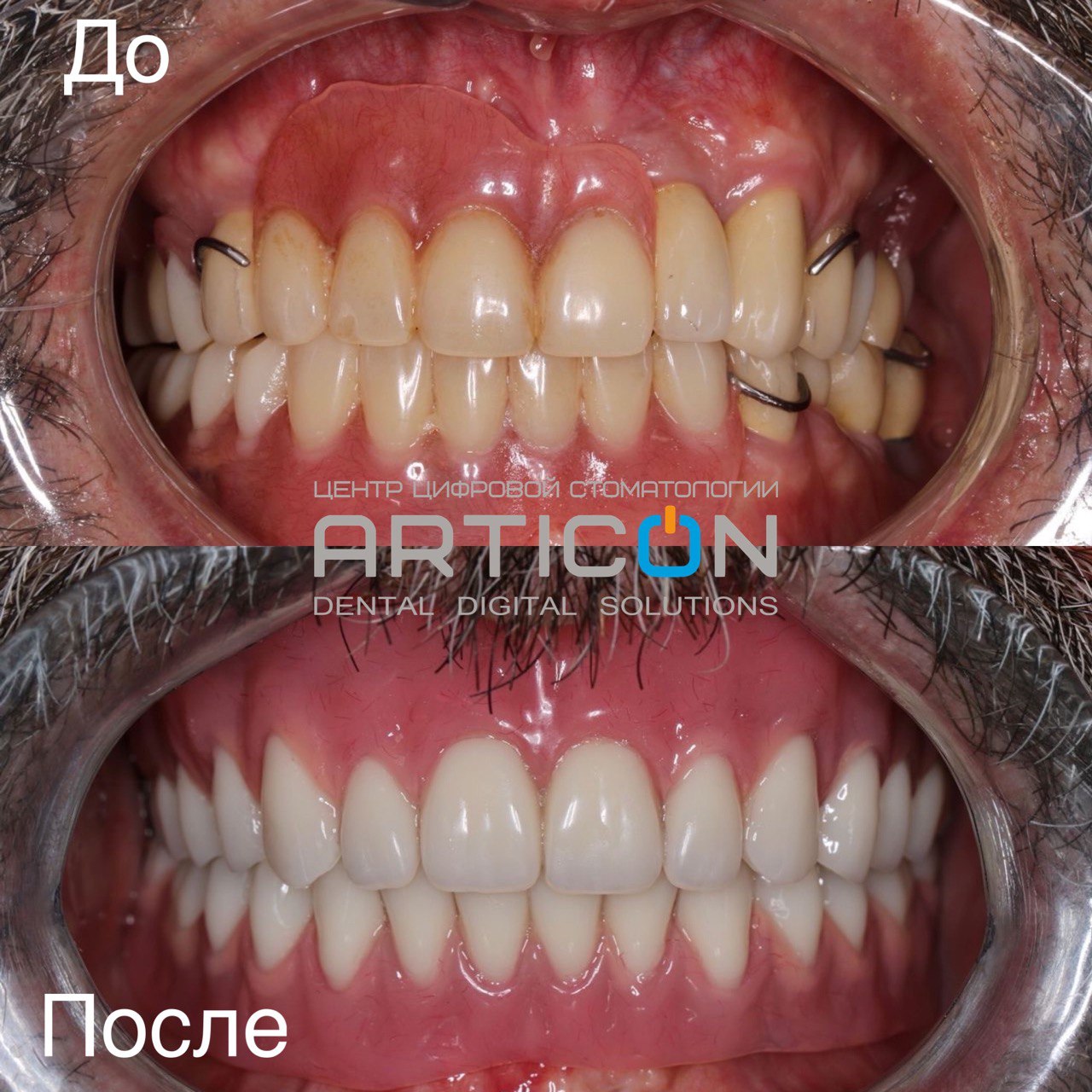 Съемное протезирование зубов в Москве в клинике Articon