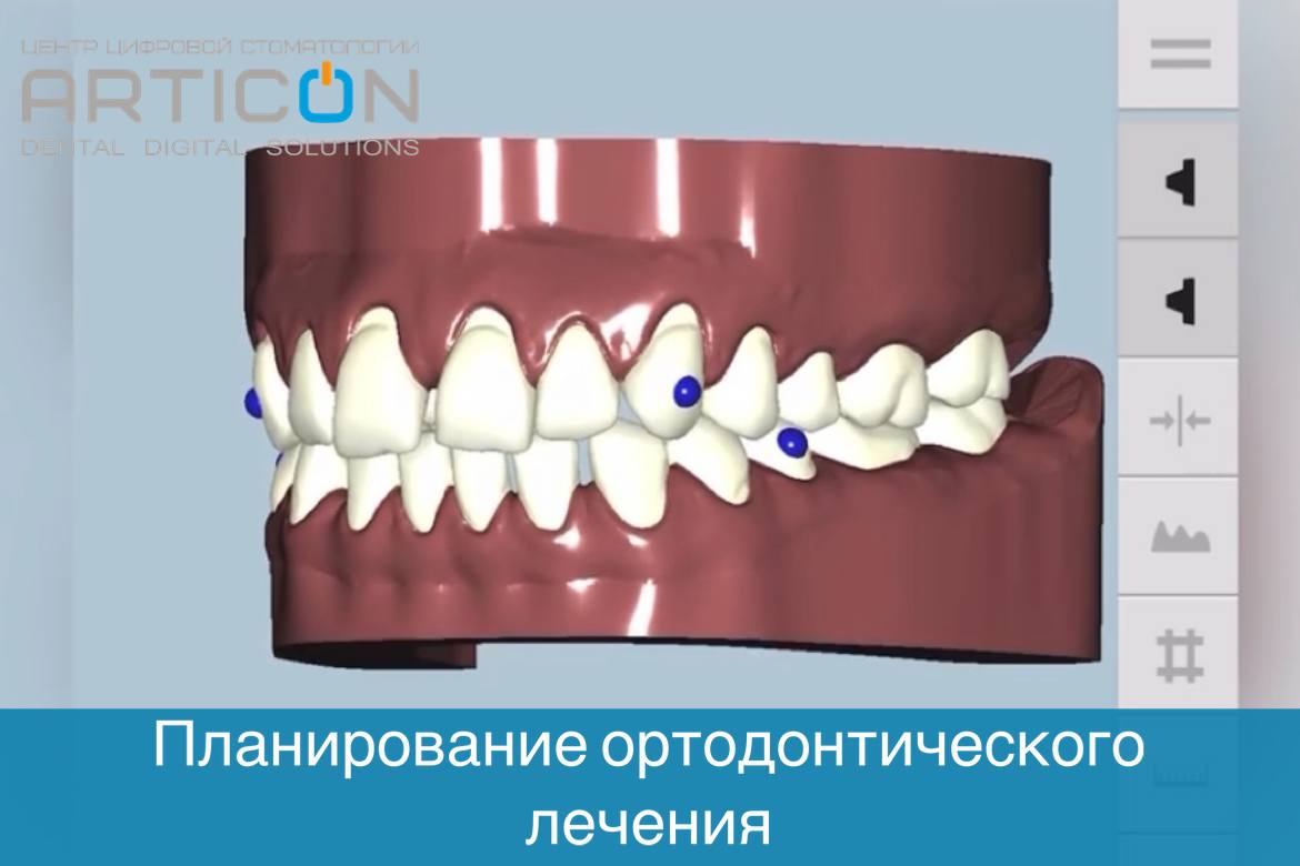 Исправление прикуса элайнерами в Москве в клинике Articon